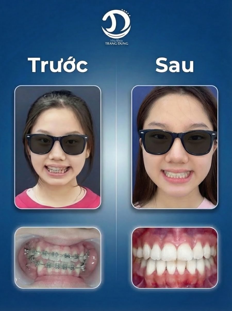 Trước và sau chỉnh nha